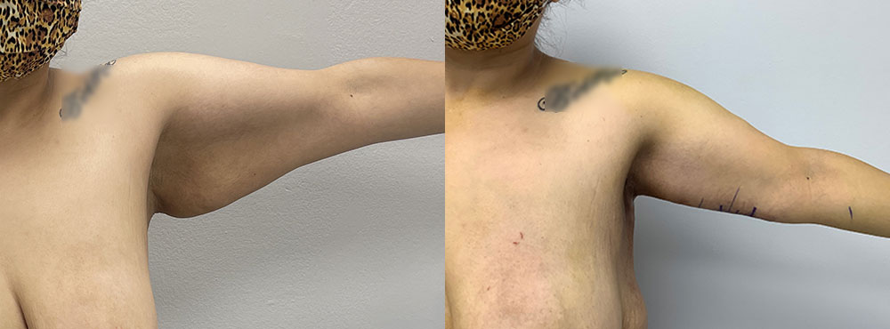 Arm Lift Before and after photo