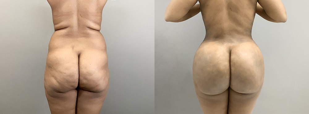 BBL Before and After