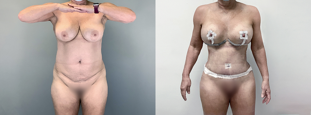 Mommy Makeover Before and After