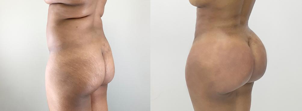 Brazilian Butt Lift Before and After