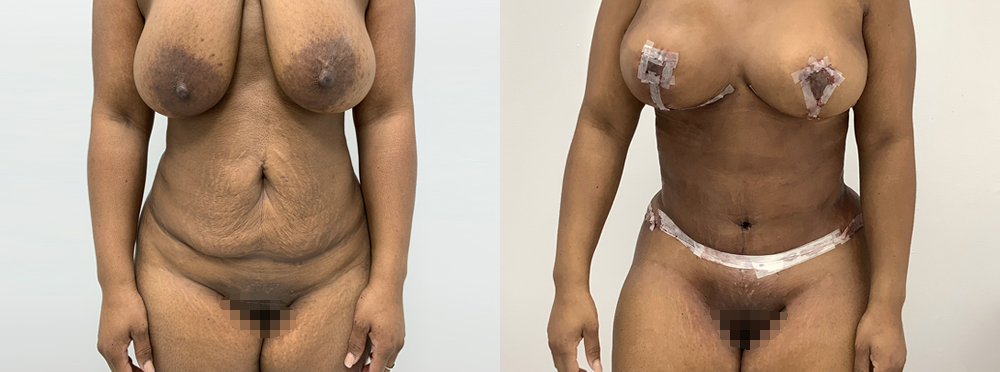 Mommy Makeover Before and After