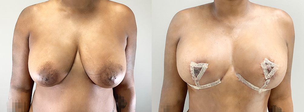 Breast Lift Before and After