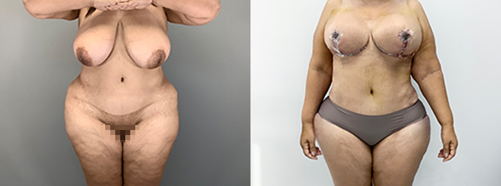 Mommy Makeover Before and After