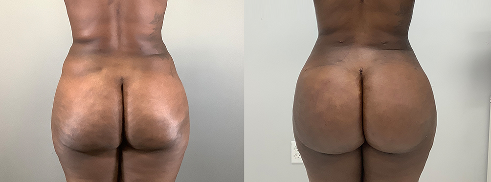 Brazilian Butt Lift Before and After