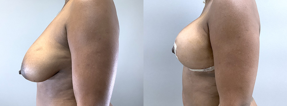 Breast Lift Before and After