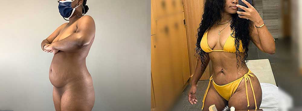 Brazilian Butt Lift Before and After