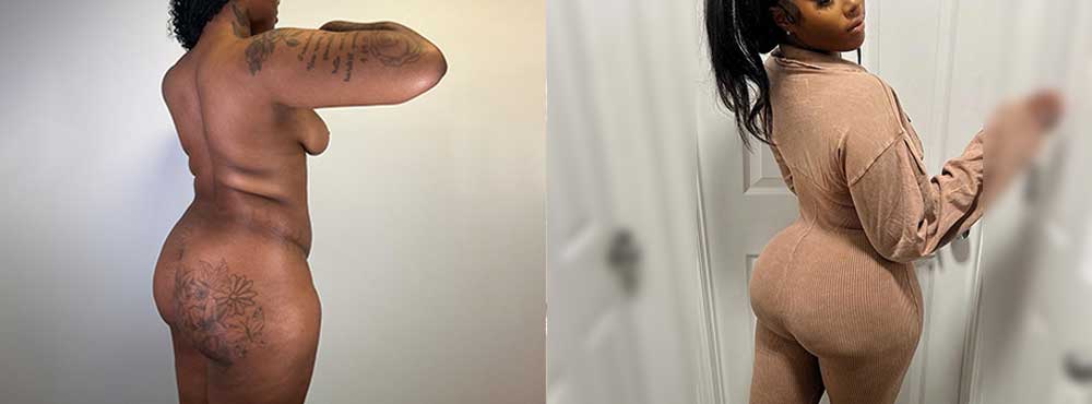Brazilian Butt Lift before and after