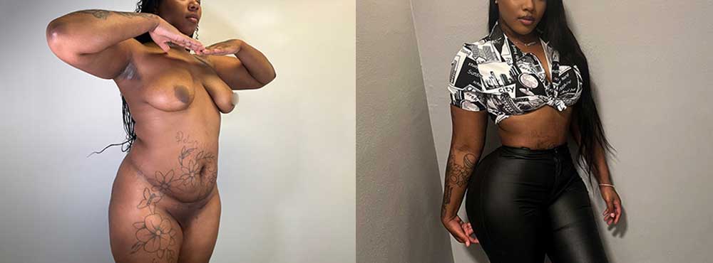 Brazilian Butt Lift before and after