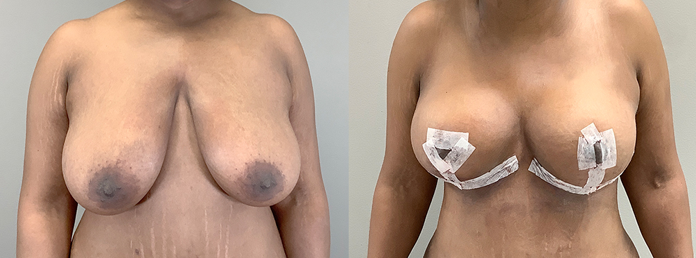 Breast Lift Before and After