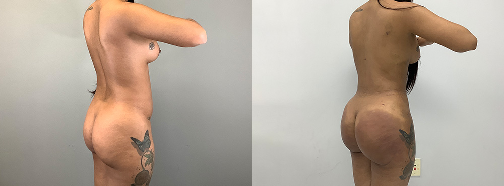 Brazilian Butt Lift before and after