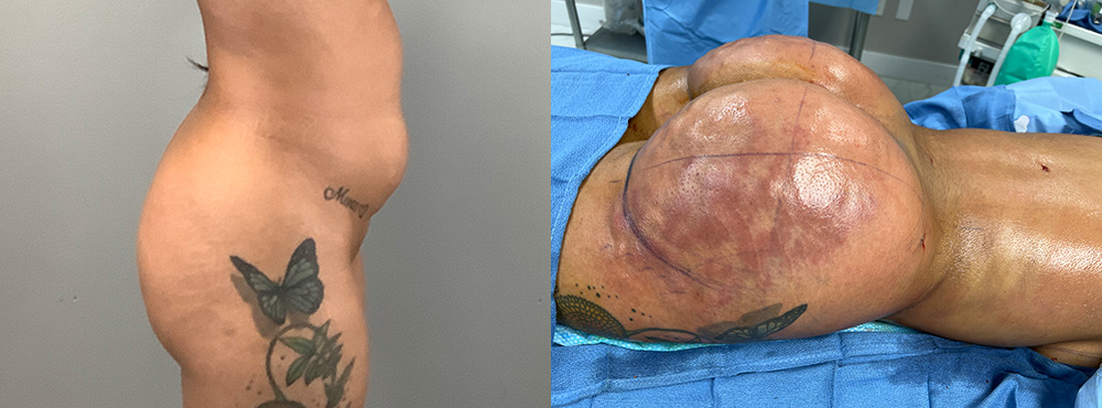 Brazilian Butt Lift before and after