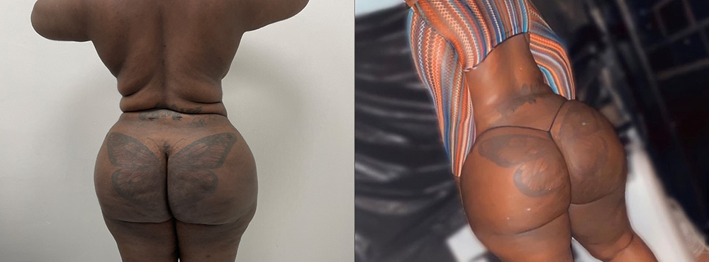 Brazilian Butt Lift Before and After
