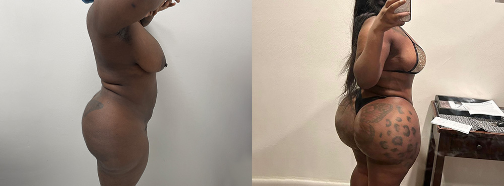 Brazilian Butt Lift Before and After