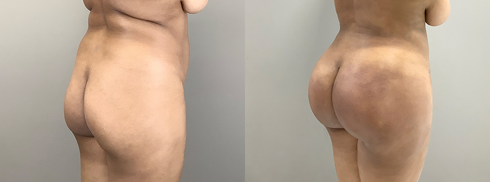 Brazilian Butt Lift Before and After