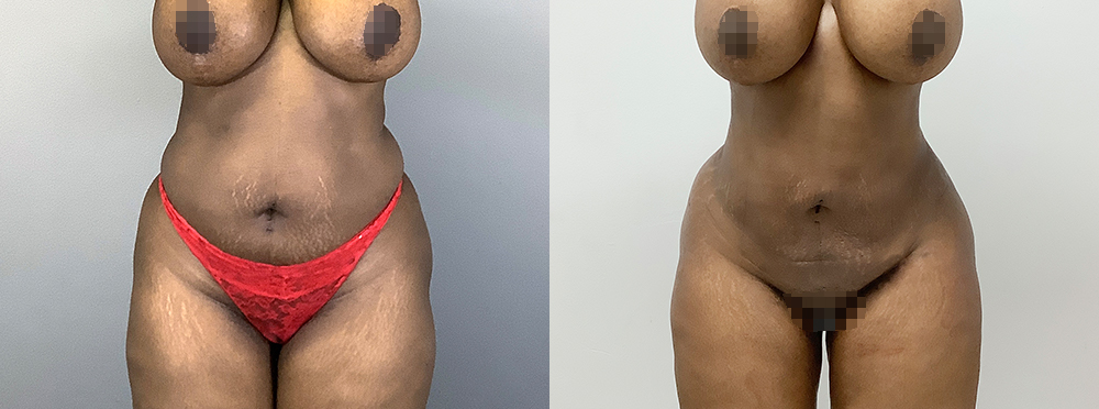 Liposuction Before and After