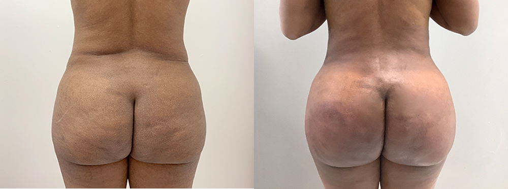 Brazilian Butt Lift Before and After
