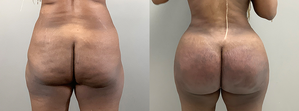 Brazilian Butt Lift Before and After