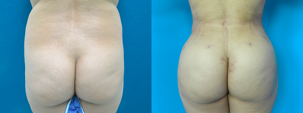Brazilian Butt Lift before and after