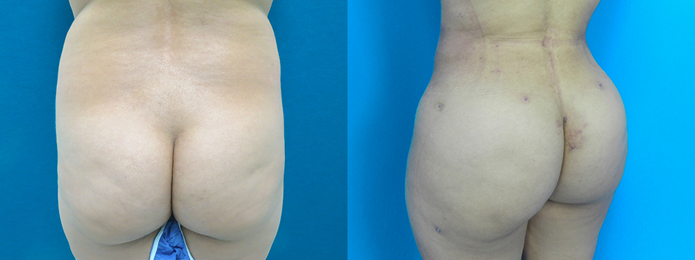 Brazilian Butt Lift before and after