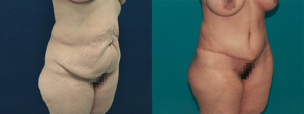 Tummy Tuck before and after