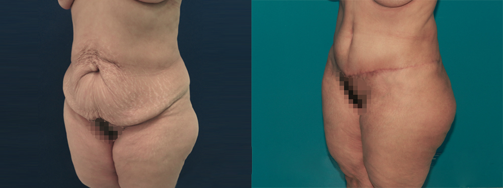 Tummy Tuck before and after