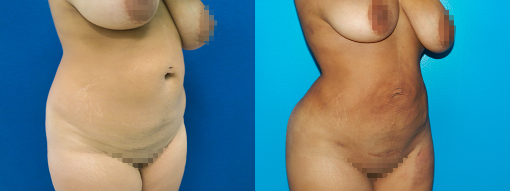 BBL before and after photos