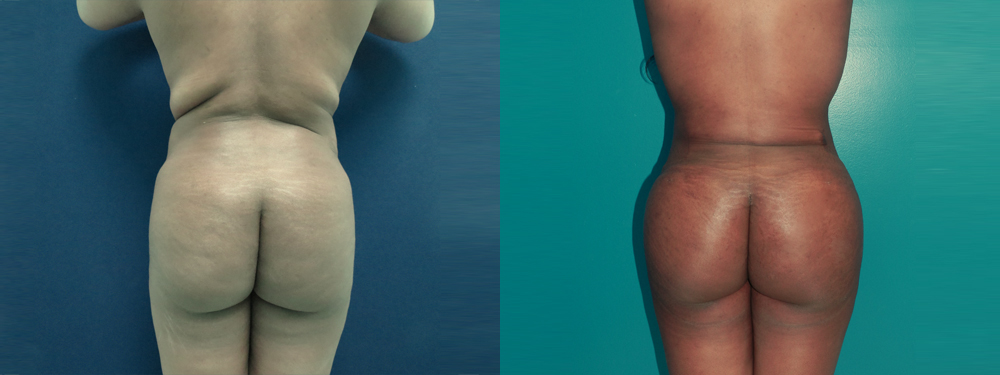 Brazilian Butt Lift before and after 
