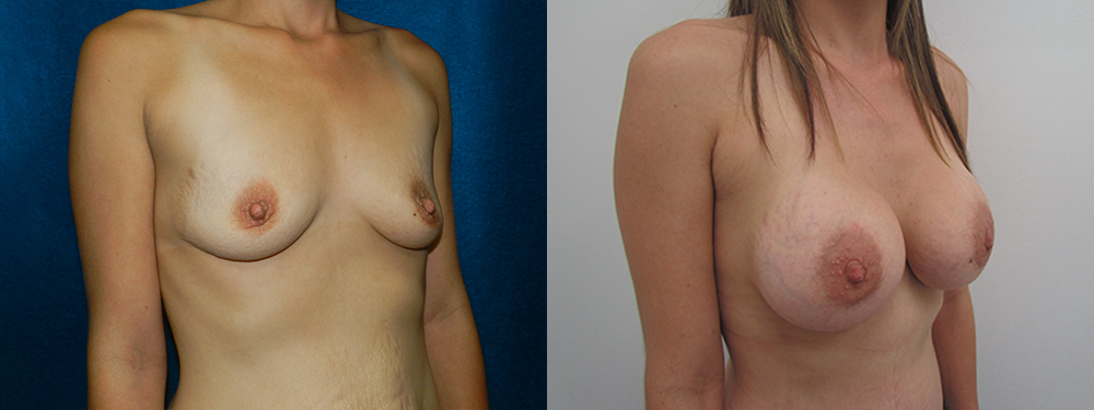 breast augmentation before and after
