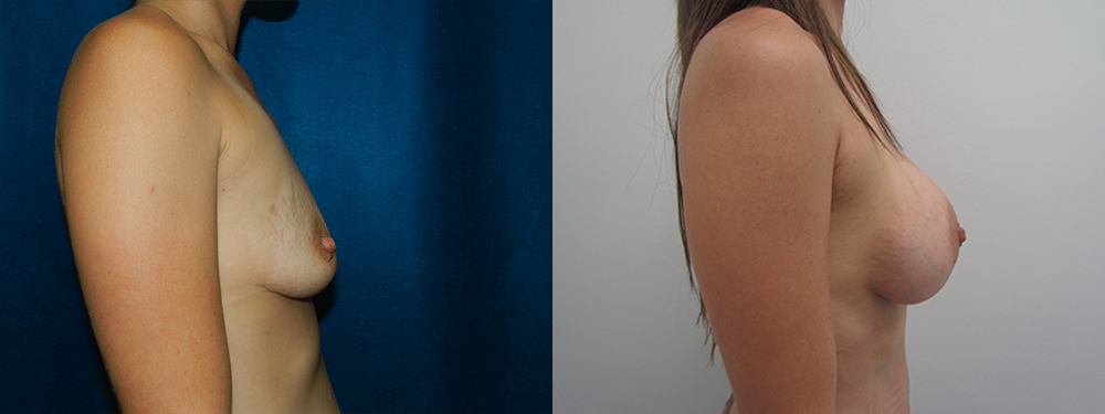 breast augmentation before and after