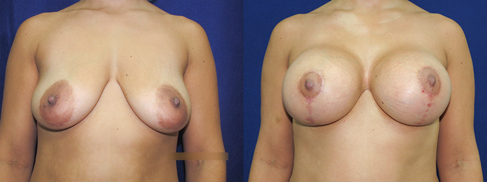 Breast Lift before and after