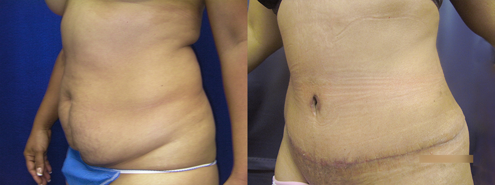Tummy Tuck before and after