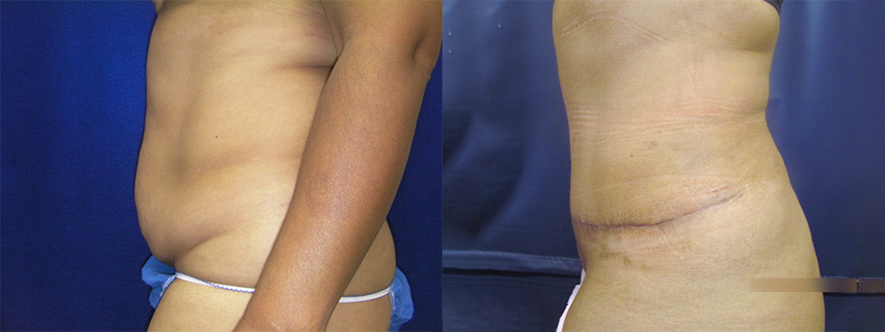 Tummy Tuck before and after
