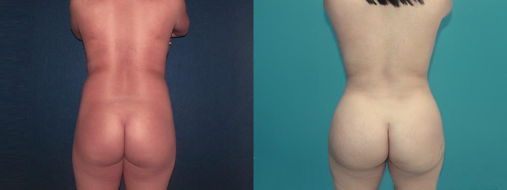 brazilian butt lift before and after