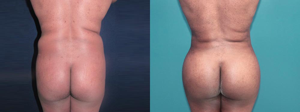 brazilian butt lift before and after