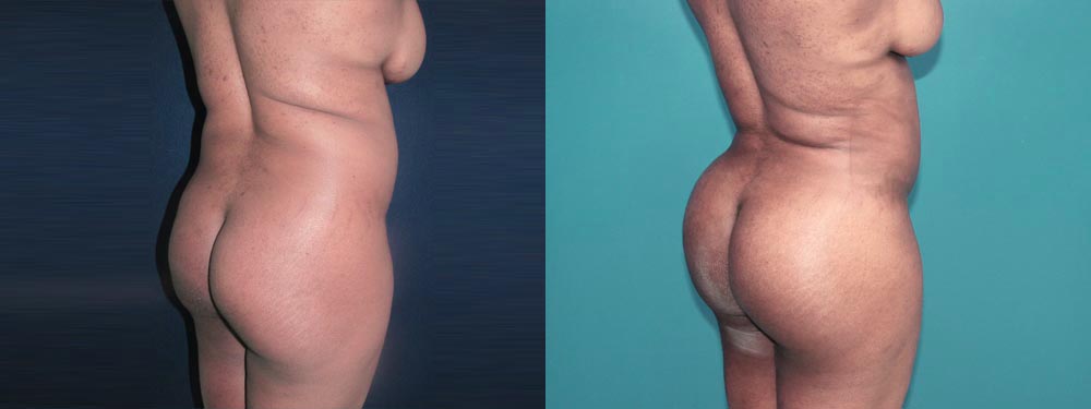 brazilian butt lift before and after