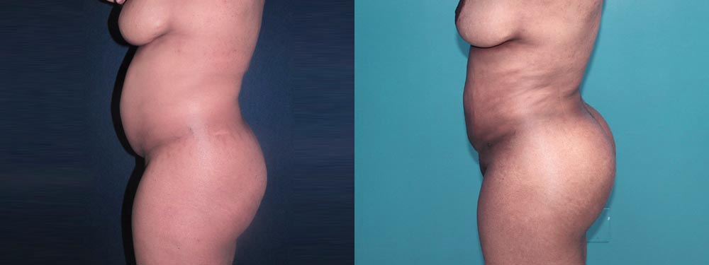 brazilian butt lift before and after