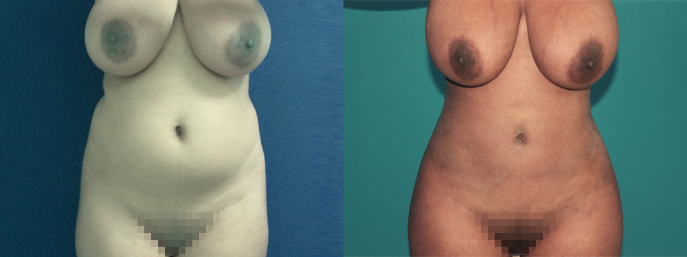 Brazilian Butt Lift before and after