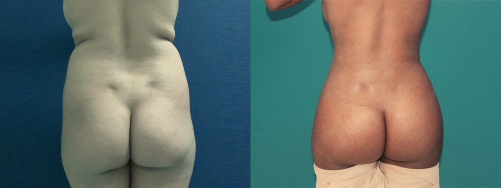 Brazilian Butt Lift before and after