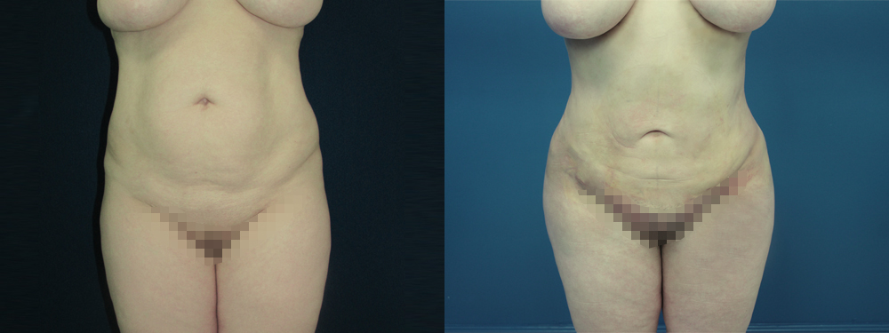 BBL before and after photos