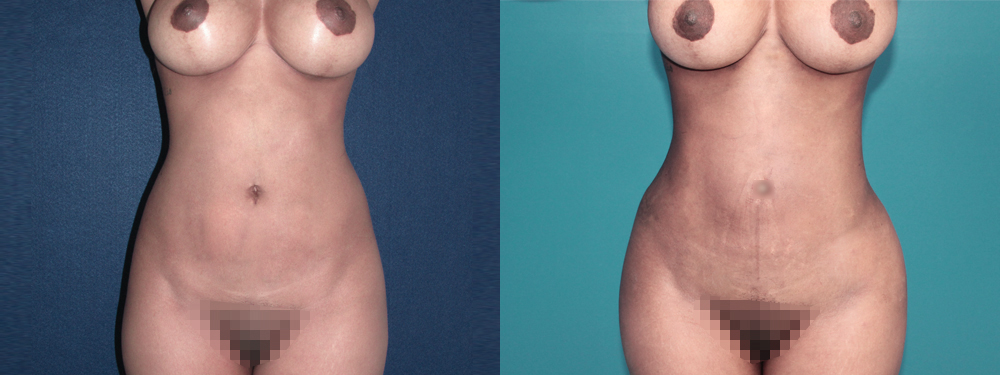 brazilian butt lift before and after