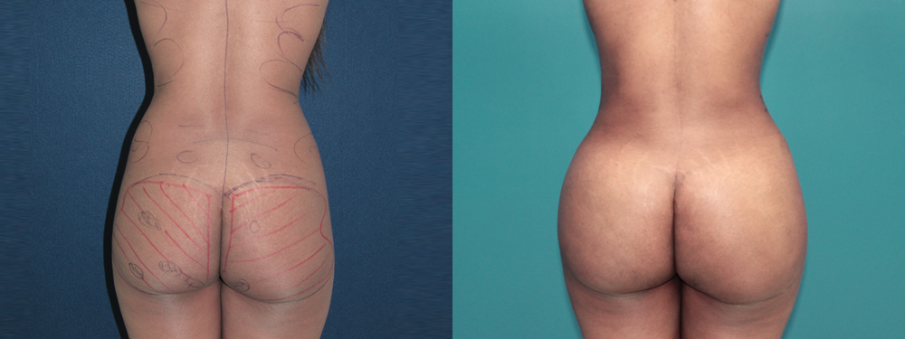 brazilian butt lift before and after
