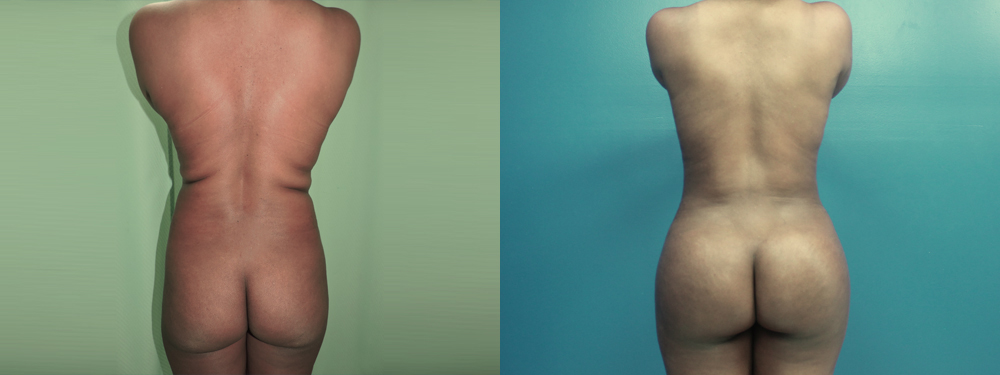 brazilian butt lift before and after