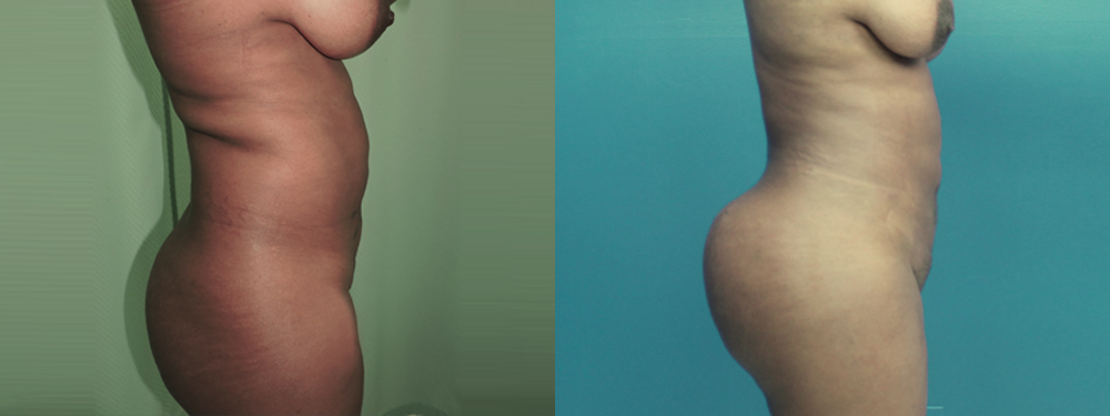 brazilian butt lift before and after