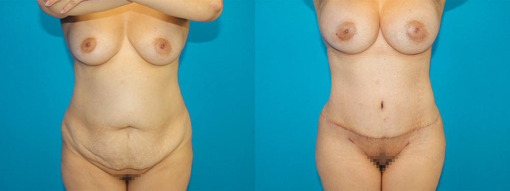 Momy Makeover before and after