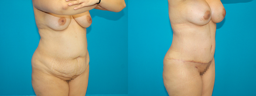 Momy Makeover before and after