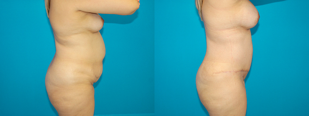 Momy Makeover before and after