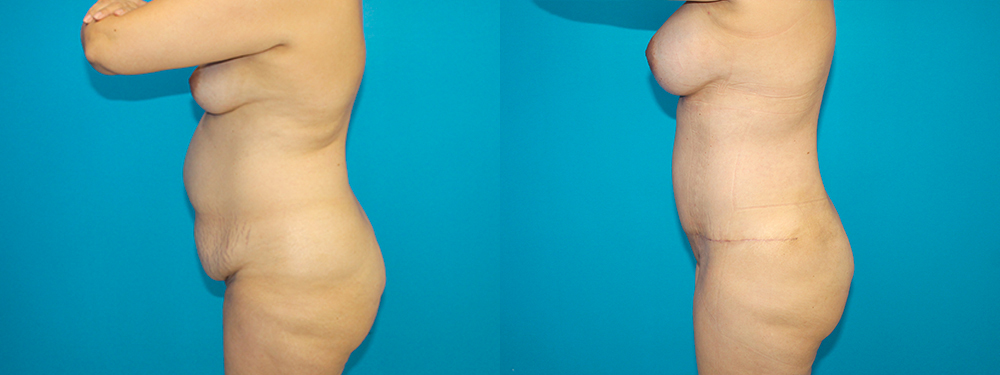 Momy Makeover before and after