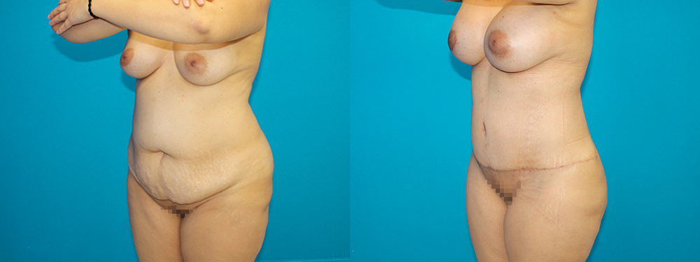 Momy Makeover before and after