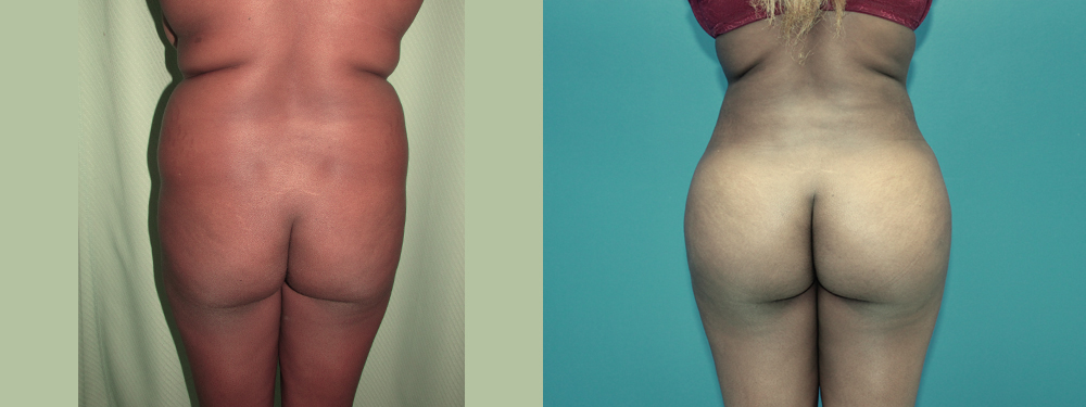 Brazilian Butt Lift before and after 