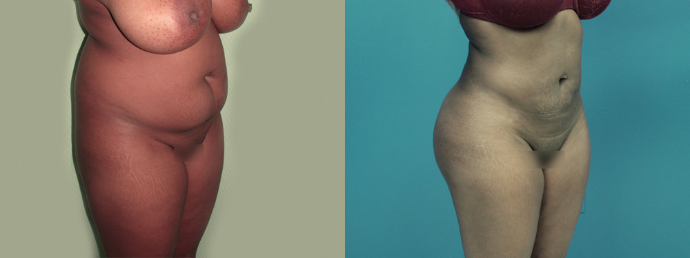 Brazilian Butt Lift before and after 